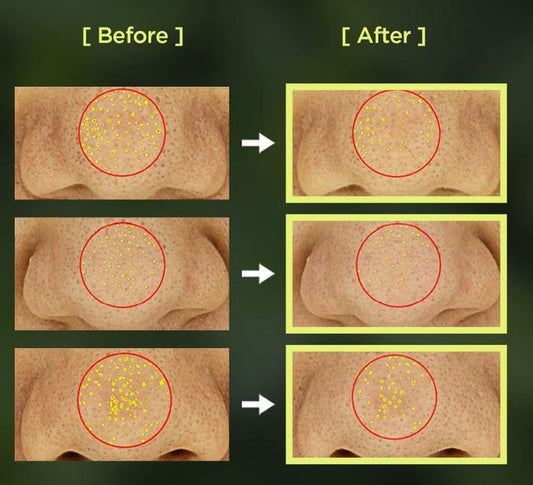 ANUA-Aceite limpiador para el control de poros Heartleaf 200 ml