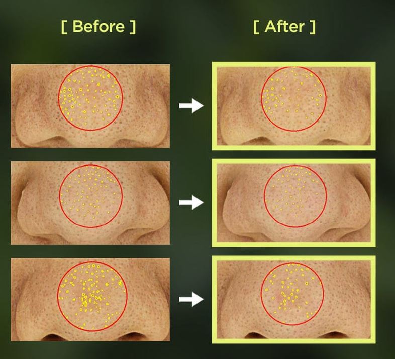 ANUA-Aceite limpiador para el control de poros Heartleaf Mini 20 ML-ayudar a limpiar los poros eliminando el maquillaje, el sebo y la suciedad.