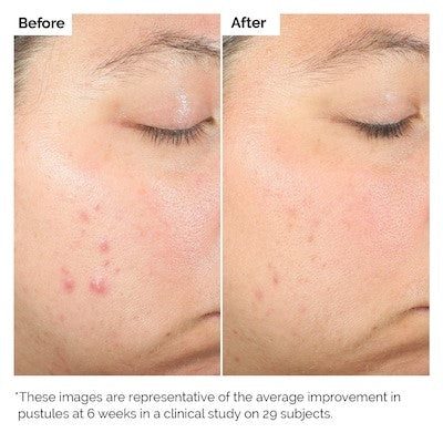 The Ordinary Solución exfoliante para imperfecciones con ácido salicílico al 2%